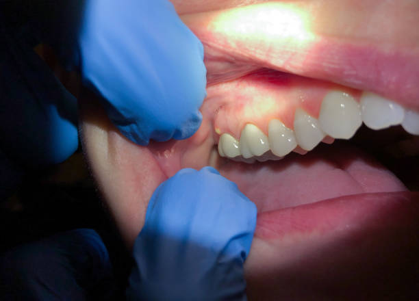 Best Emergency Treatment for Toothache in Bellaire, OH